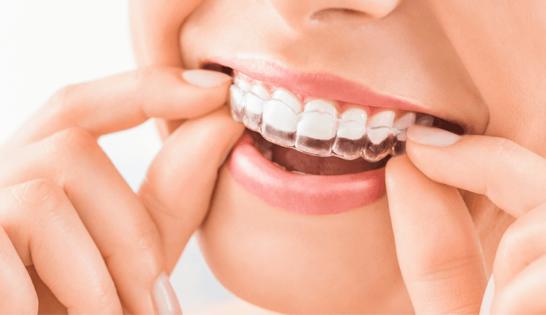 Invisalign oikomishoito | jopa -24 % | Tallinna * - Invisalign oikomishoito ylä- alahampaille